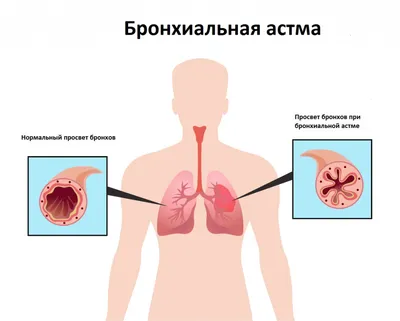 Как остановить приступ кашля: 10 лучших способов для взрослых с отзывами,  советами врачей