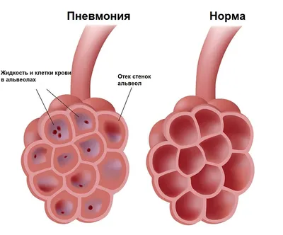 Городская клиническая больница 13 - Уфа - Всемирный день борьбы с  туберкулезом отмечается ежегодно 24 марта во всем мире по решению Всемирной  организации здравоохранения и Международного союза борьбы с туберкулезом и  легочными