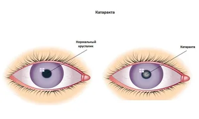 Детская катаракта. Симпотомы и лечение. Барселона