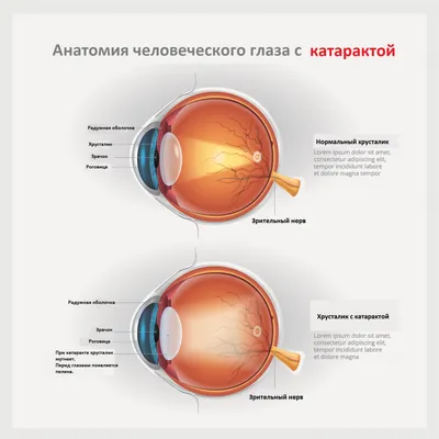 Лечение катаракты -Услуги