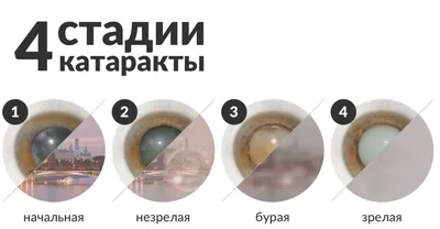 Лечение осложненной катаракты в Москве, диагностика и лечение катаракты в  Центре Терапевтической Офтальмологии