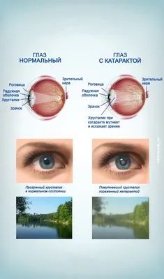 Что такое полярная катаракта?