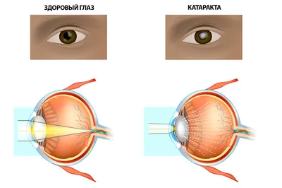 Катаракта у детей