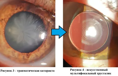 Что такое катаракта? | Блог