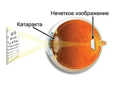 Зрелая катаракта - Офтальмика