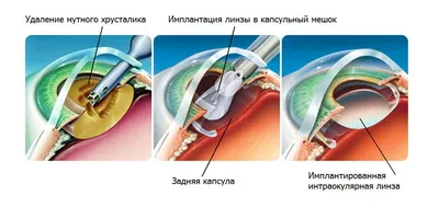 Катаракта у пожилых людей: симптомы и лечение | Пансионат \"Забота о близких\"