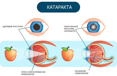 Лечение катаракты в Санкт-Петербурге: цены на операцию катаракты в клинике  ЮВТ