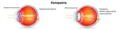 🔸 Катаракта в пожилом возрасте - Прогресс Пансион