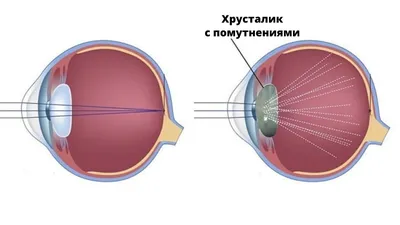 Начальная стадия катаракта лечение