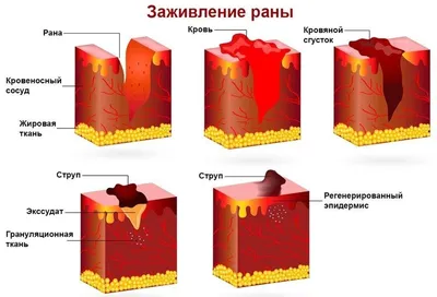 Виды рубцов. | ВКонтакте