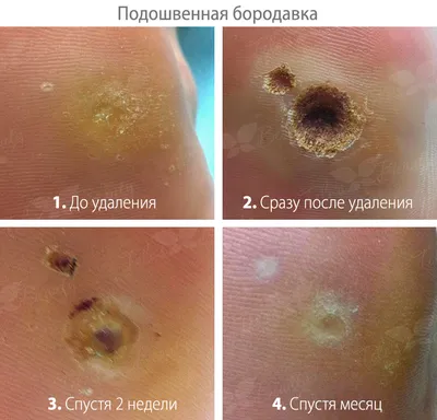 Кератомы на теле (фото заболевания в конце) | Советы  дерматолога|Sovetydermatologa | Дзен