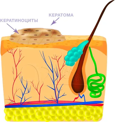 Удаление кератом в Москве | Лечение кератомы кожи на лице / теле, лечение  себорейных, старческих кератом в Клинике подологии Полёт