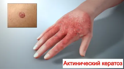 N.Ayva Med Aesthetic Center on Instagram: \"Фолликулярный кератоз Причины и  симптомы патологии, диагностика и лечение болезни. Фолликулярный кератоз  представляет собой группу кожных заболеваний, которые сопровождаются  гиперкератозом и закупоркой ...