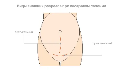 Операция кесарево сечение