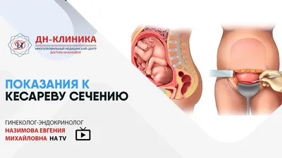 Кесарево сечение - «Как не бояться кесарева сечения? Какие последствия кесарева  сечения? Как на меня не подействовал наркоз. Моя история и предыстория  планового кесарева сечения. Много текста.» | отзывы