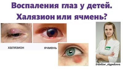 Александр Тесленко - Халязион. Что это? Почему? Пройдет само? Худший  сценарий? Как лечить? Как проходит операция? Как не лечить? Халязион –  «киста» внутри века (в толще века), которая образовывается после воспаления  сальной