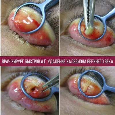 Офтальмологи КГБ № 1: что такое халязион и как его лечить | Новости  Красногорска