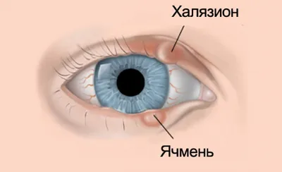 Халязион - симптомы и лечение у детей и взрослых: препараты, капли, цены