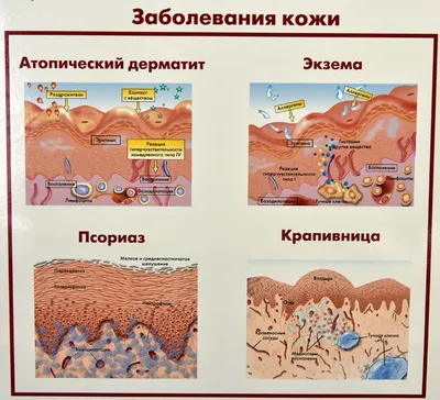 Себорея кожи головы, лица - лечение в СПб - жирная, сухая себорея | Клиника  МедПросвет