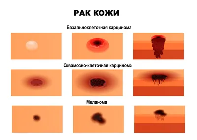 Медицинский центр \"Ваш Доктор\" - Хеликобактер пилори – это небольшая  бактерия спиралевидной формы, которая может обитать на слизистой желудка и  двенадцатиперстной кишки. Если человек заразился ею, то она обитает на  слизистой желудка