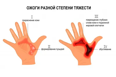 Сильнейший химический ожог, вызванный аллергической реакцией на татуировку  хной. | Instagram