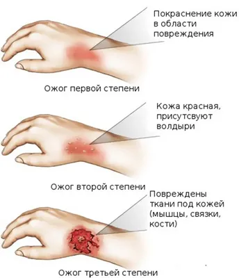 Химический ожог: классификация, первая помощь, лечение