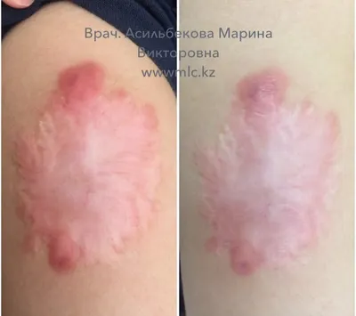 Лазерное удаление шрамов на лице в Киеве, шлифовка Coolaser Clinic