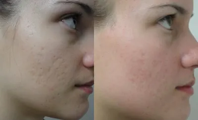 Как избавиться от шрамов и рубцов на лице и теле | Клиника “Elevans”