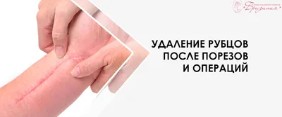 Лазерное удаление шрамов и рубцов в Минске, цены