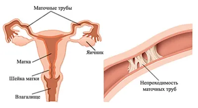 Хламидиоз – симптомы и последствия. Курс лечения хламидиоза.