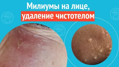 Болезни сердца - кожные симптомы и необходимая диагностика