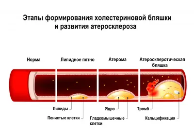 Скрытая угроза: медики рассказали о симптоме повышенного холестерина |  Статьи | Известия