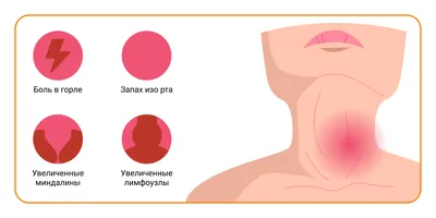 Как лечить хронический и острый тонзиллит: симптомы и препараты для  взрослых и детей