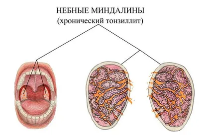 Когда нужно удалять гланды? Выбор тактики лечения при хроническом тонзиллите