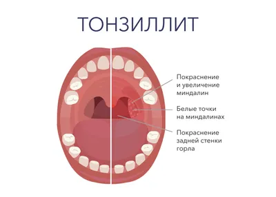 Тонзиллит - причины появления, симптомы заболевания, диагностика и способы  лечения