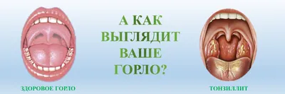 Тонзиллит у детей - причины, симптомы, лечение в клинике «Будь Здоров»