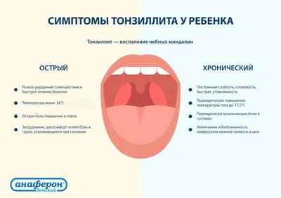 Тонзиллит у детей - причины, симптомы, лечение в клинике «Будь Здоров»