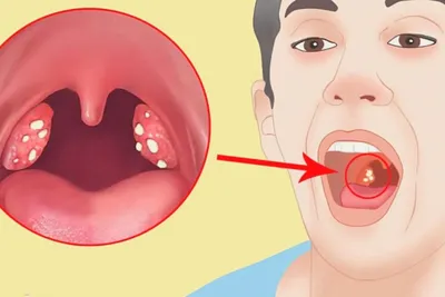 Хронический тонзиллит или болезнь, которой нет | Клиника Рассвет