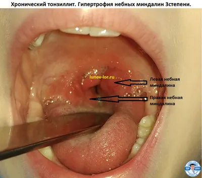 Хронический тонзиллит - фото - ЛОР в Самаре - врач Лунёв Андрей Владимирович