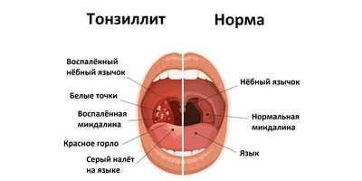 Лечение острого и хронического тонзиллита в Лекафарм, цены в СПб | Лека-Фарм