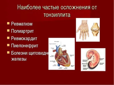 Хронический тонзиллит: симптомы и лечение | Клиника Эксперт