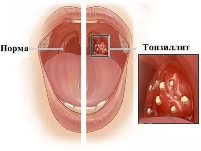 Хронический тонзиллит