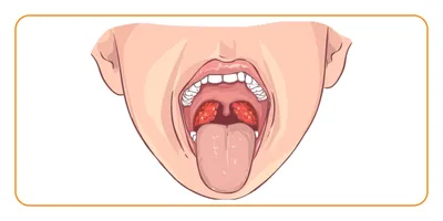 Хронический тонзиллит: как с ним жить?