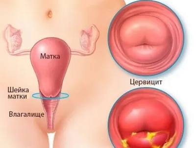 Гистероскопия,хронический цервицит — 8 ответов | форум Babyblog