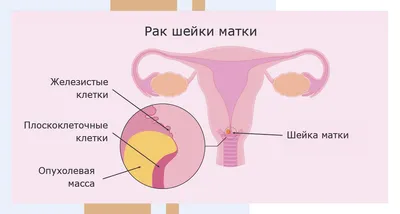 Лечение цервицита: симптомы и причины - частная клиника R+