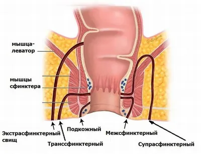 Хронический парапроктит. Свищ | Пикабу