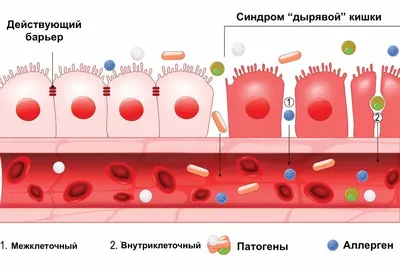 Дырявый кишечник — миф или реальность