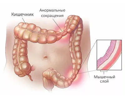 Синдром раздраженного кишечника: клиническая картина и лечение | МДЦ  «Олимп» в Москве