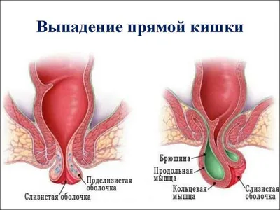 Выпадение прямой кишки — симптомы, причины, лечение