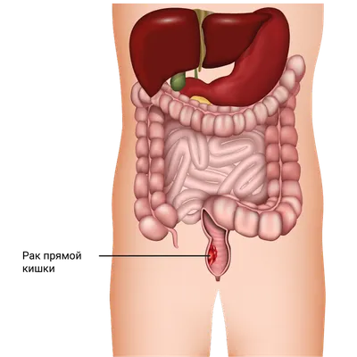 Рак прямой кишки - Рак пищеварительной системы